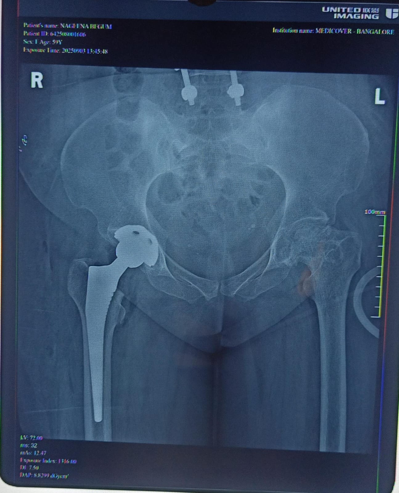 After hip fracture fixation X-ray with plate and screws